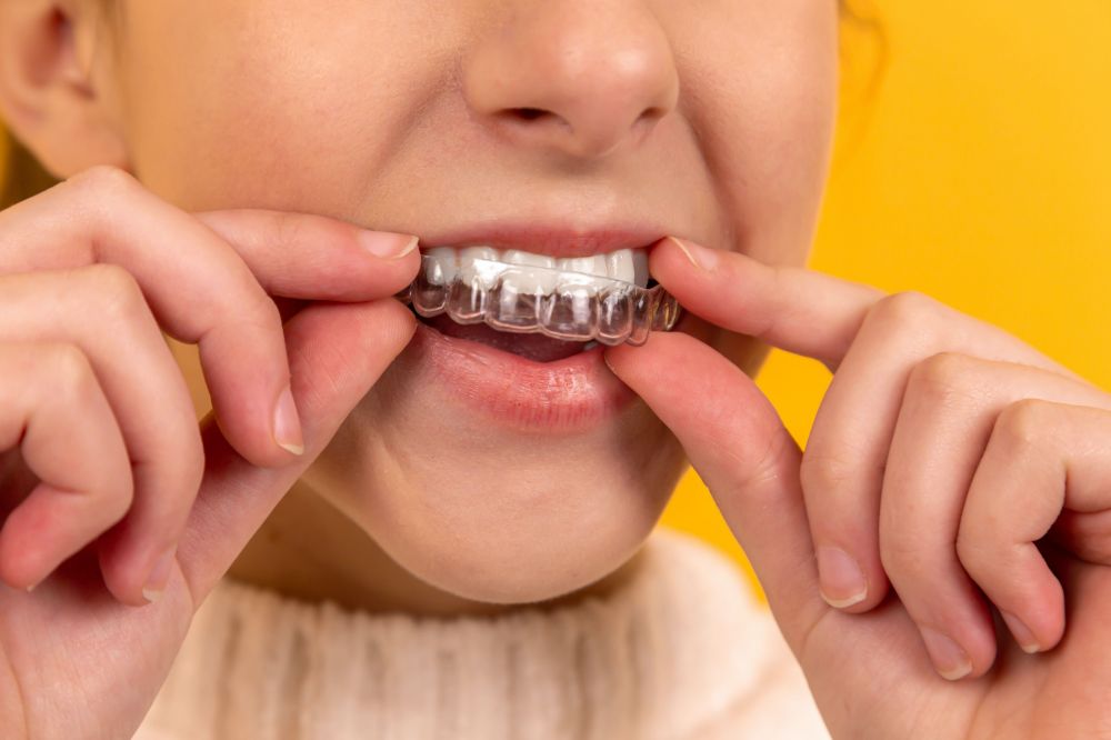Tandställning - Korrigera din tandställning för ett vackert leende